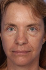 Eyelid Surgery Before and after photo