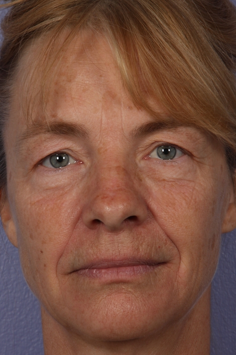 Eyelid Surgery before and after photo