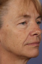 Eyelid Surgery Before and after photo