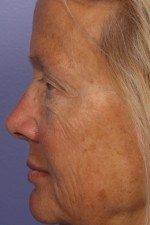 Eyelid Surgery