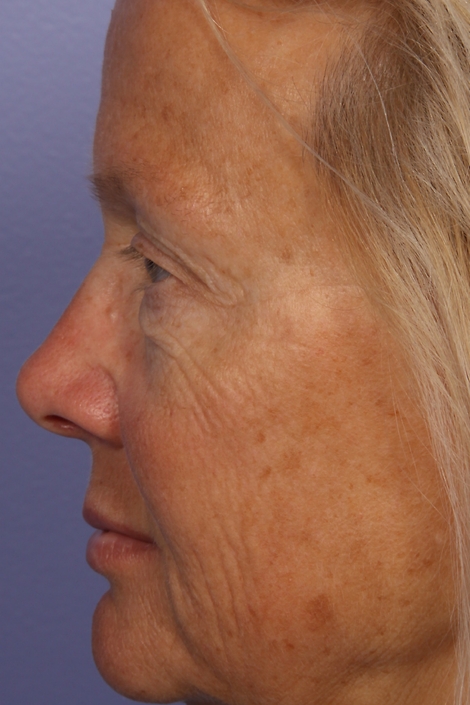 Eyelid Surgery before and after photo