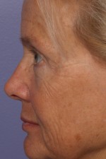 Eyelid Surgery Before and after photo