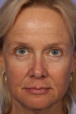 Eyelid Surgery Before and after photo