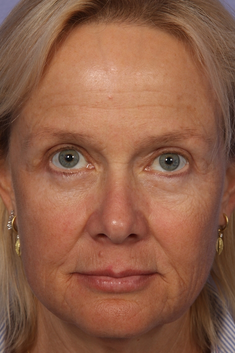 Eyelid Surgery before and after photo