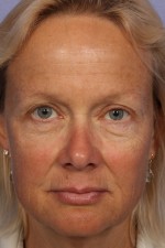 Eyelid Surgery Before and after photo