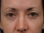 Eyelid Surgery Before and after photo