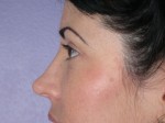 Eyelid Surgery Before and after photo