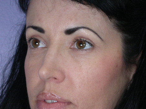 Eyelid Surgery before and after photo