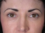 Eyelid Surgery