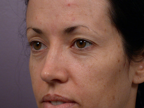 Eyelid Surgery before and after photo