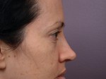 Eyelid Surgery Before and after photo