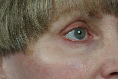 Injectable Fillers before and after photo