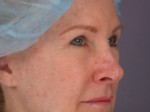 Eyelid Surgery