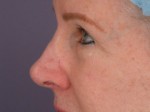 Eyelid Surgery Before and after photo