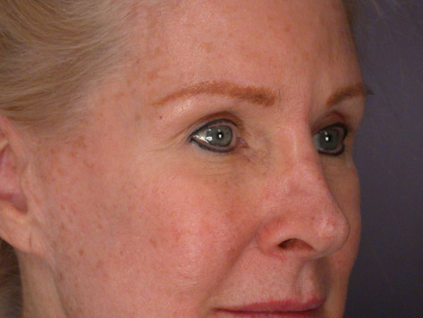 Eyelid Surgery before and after photo