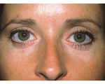 Eyelid Surgery Before and after photo