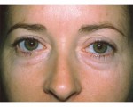 Eyelid Surgery