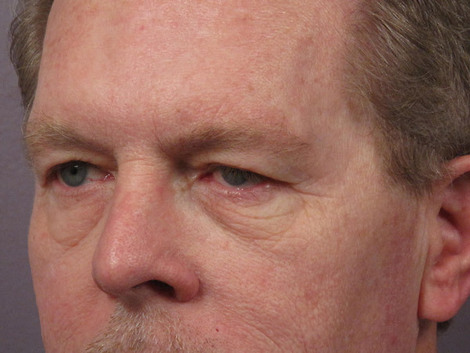 Eyelid Surgery before and after photo