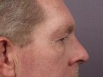 Eyelid Surgery Before and after photo