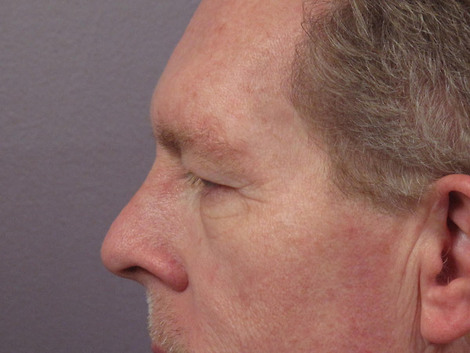 Eyelid Surgery before and after photo