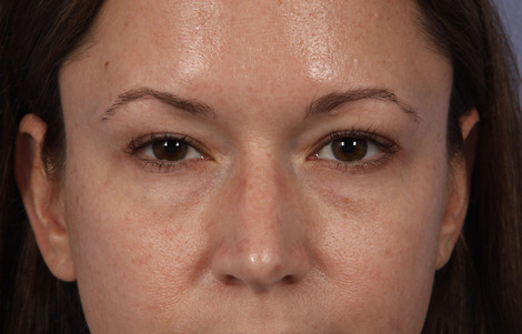 Eyelid Surgery before and after photo