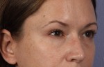 Eyelid Surgery Before and after photo