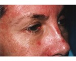 Eyelid Surgery