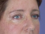 Eyelid Surgery Before and after photo