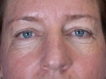 Eyelid Surgery Before and after photo