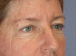 Eyelid Surgery