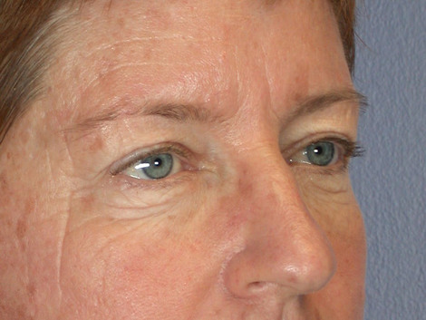 Eyelid Surgery before and after photo