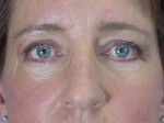 Eyelid Surgery