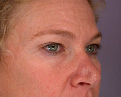 Eyelid Surgery before and after photo