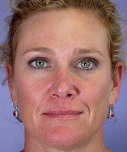 Eyelid Surgery before and after photo