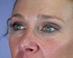 Eyelid Surgery Before and after photo