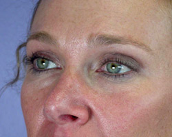 Eyelid Surgery before and after photo