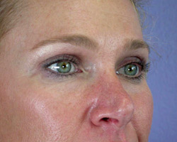 Eyelid Surgery before and after photo