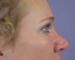 Eyelid Surgery Before and after photo