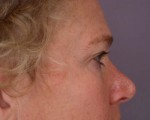 Eyelid Surgery Before and after photo