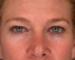 Eyelid Surgery Before and after photo