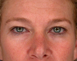 Eyelid Surgery before and after photo