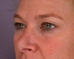 Eyelid Surgery Before and after photo