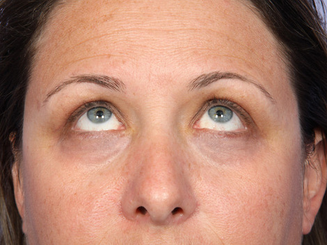 Eyelid Surgery before and after photo