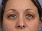 Eyelid Surgery Before and after photo