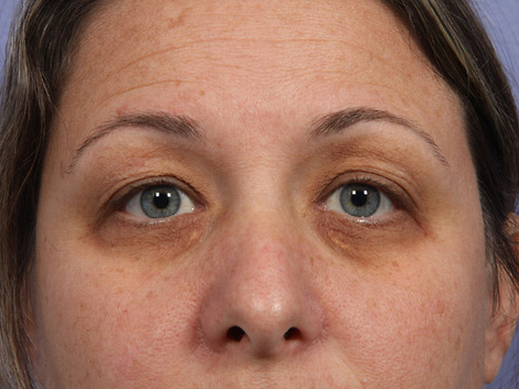 Eyelid Surgery before and after photo