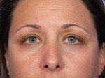 Eyelid Surgery