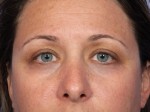 Eyelid Surgery