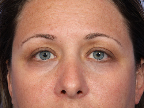 Eyelid Surgery before and after photo