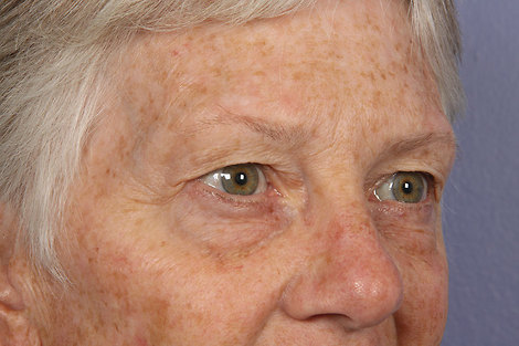 Eyelid Surgery before and after photo