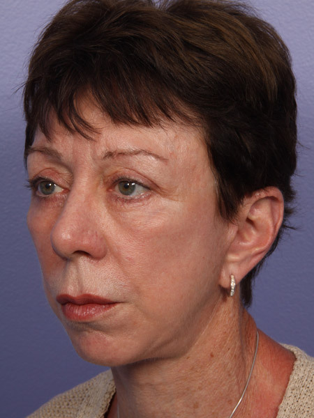 Eyelid Surgery before and after photo